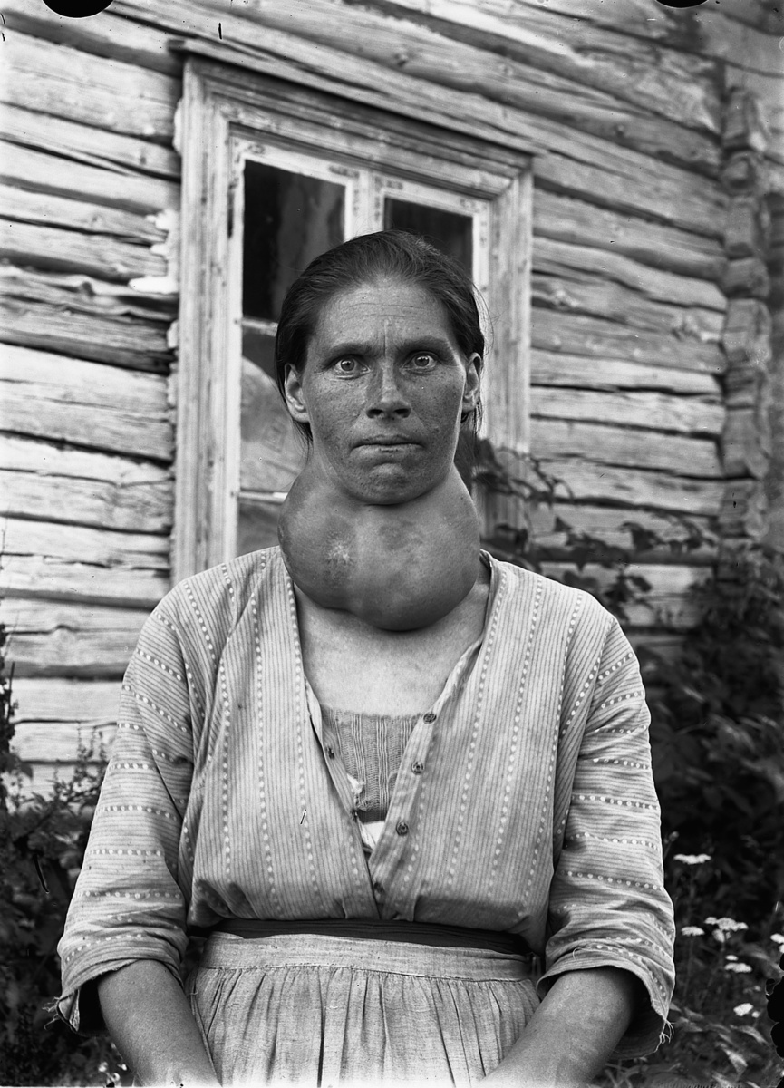 Martin Finborud, KVINNE MED STOR STRUMA. LUNDSTEN, NES. Mina Lundstein, f. 1885.