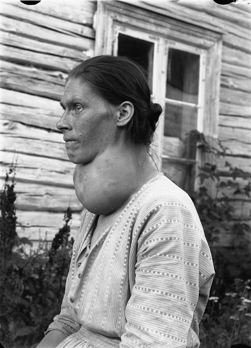 Martin Finborud, KVINNE MED STOR STRUMA. LUNDSTEN, NES. Bildet antagelig tatt for Dr. Carl Schiøtz. Mina Lundstein, f. 1885.